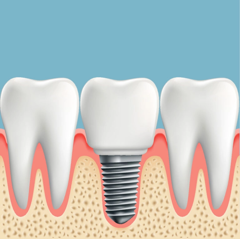 Blog 15 Quali sono gli impianti dentali migliori?