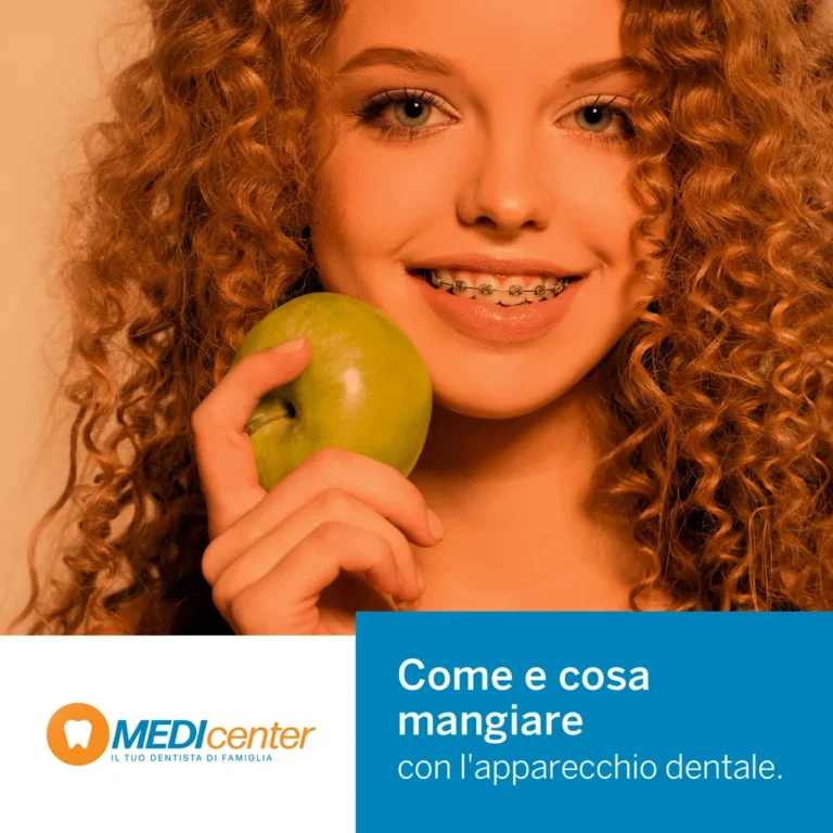 Blog 10 Come e cosa mangiare con l'apparecchio dentale
