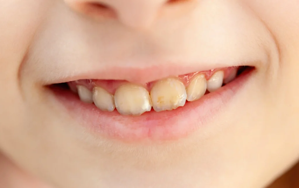 Denti gialli nei bambini