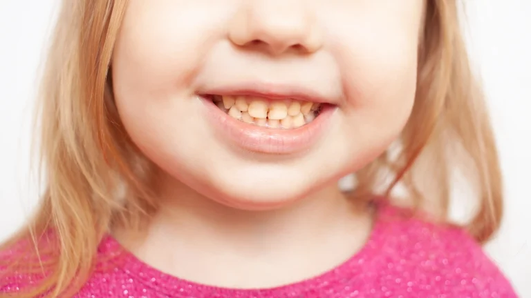 Blog 6 Denti gialli nei bambini