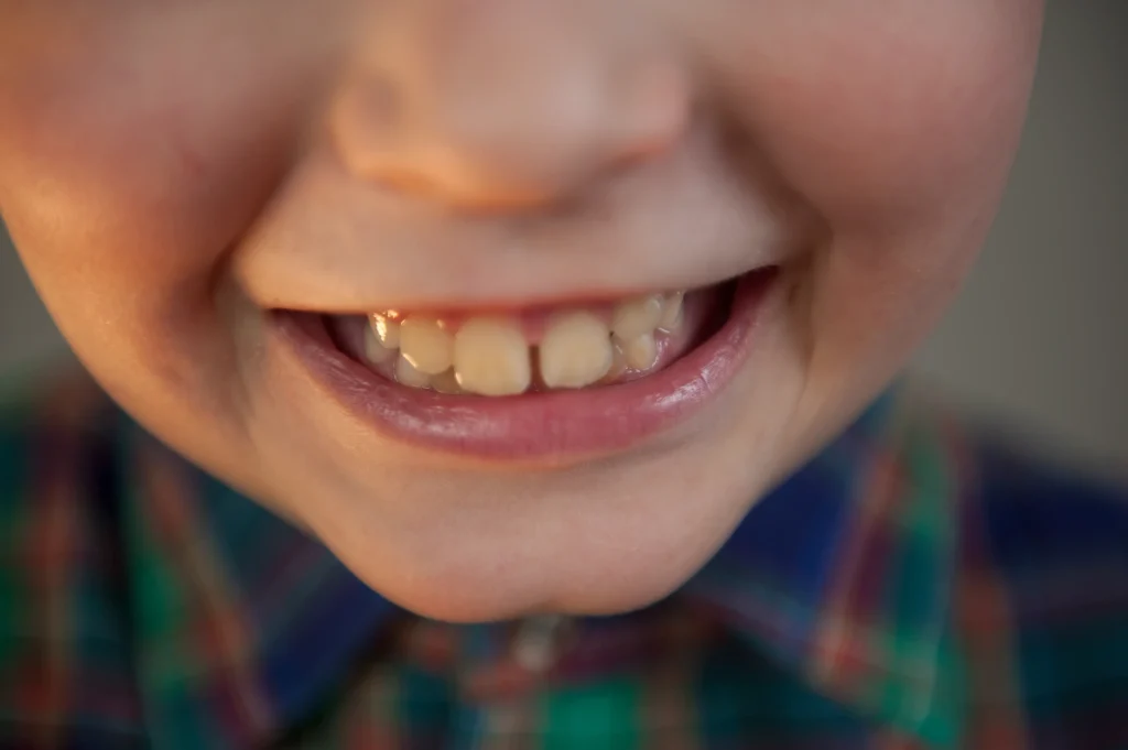 Denti permanenti nei bambini: quando spuntano e cosa fare se tardano ad arrivare 1 Denti permanenti nei bambini