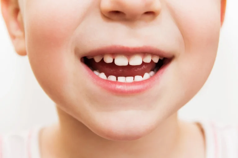 Blog 13 Denti permanenti nei bambini