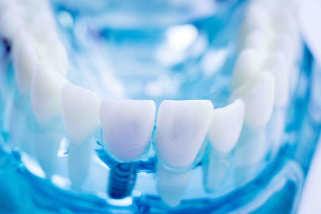 Cosa mangiare dopo un impianto dentale