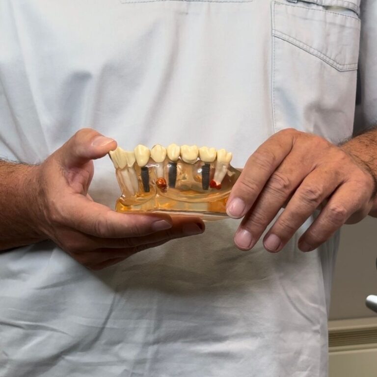 riposo dopo impianto dentale