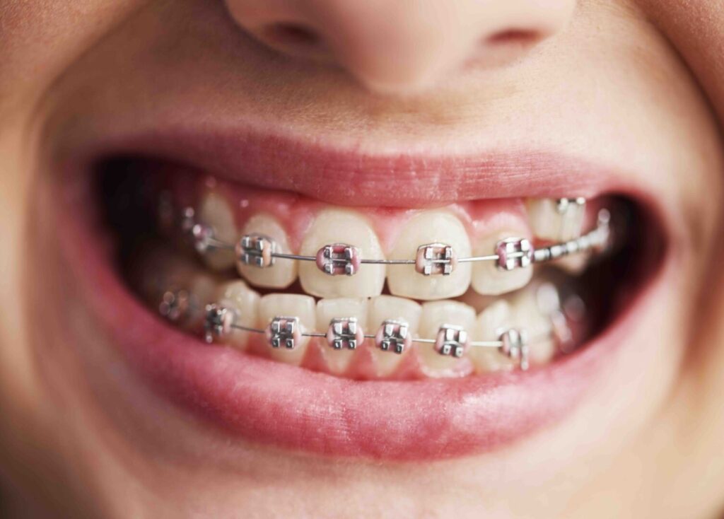 Guida completa ortodonzia: come ottenere un sorriso allineato e funzionale a Ronchi dei Legionari 1 Guida completa ortodonzia