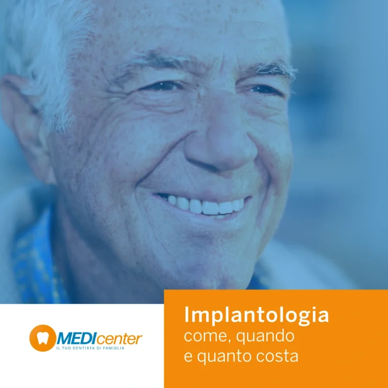 Blog 7 Implantologia, come quando e quanto costa