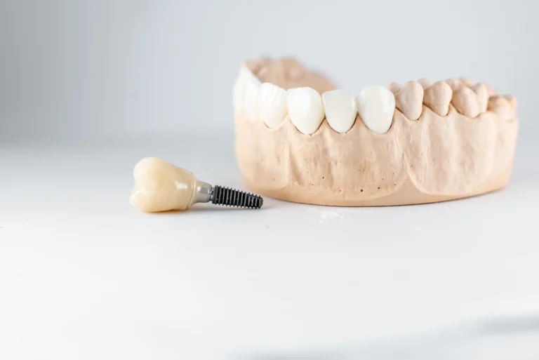 Blog 12 Tempistiche per un impianto dentale