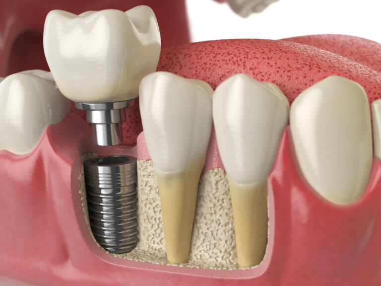 Implantologia dentale come funziona