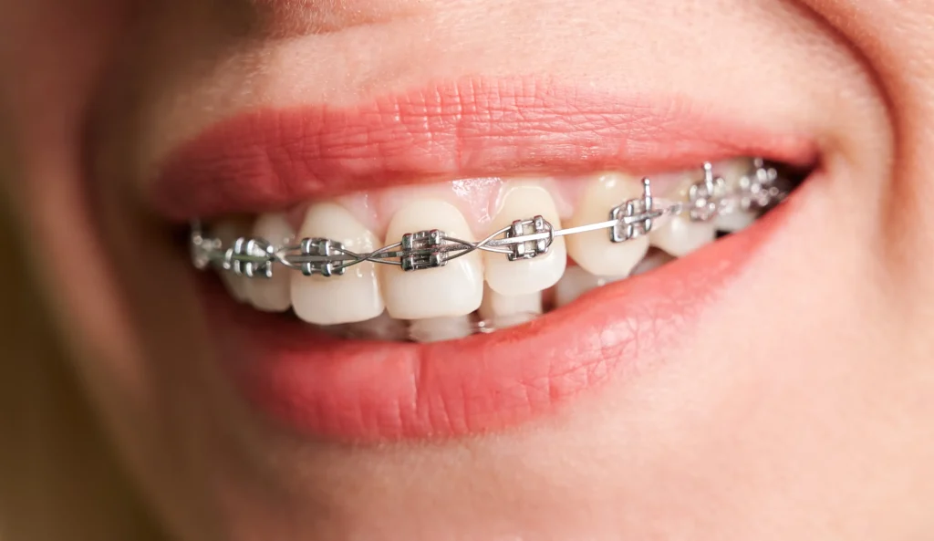 Quanto costa l’apparecchio per i denti? Da cosa dipende il trattamento ortodontico 1 Quanto costa l’apparecchio per i denti