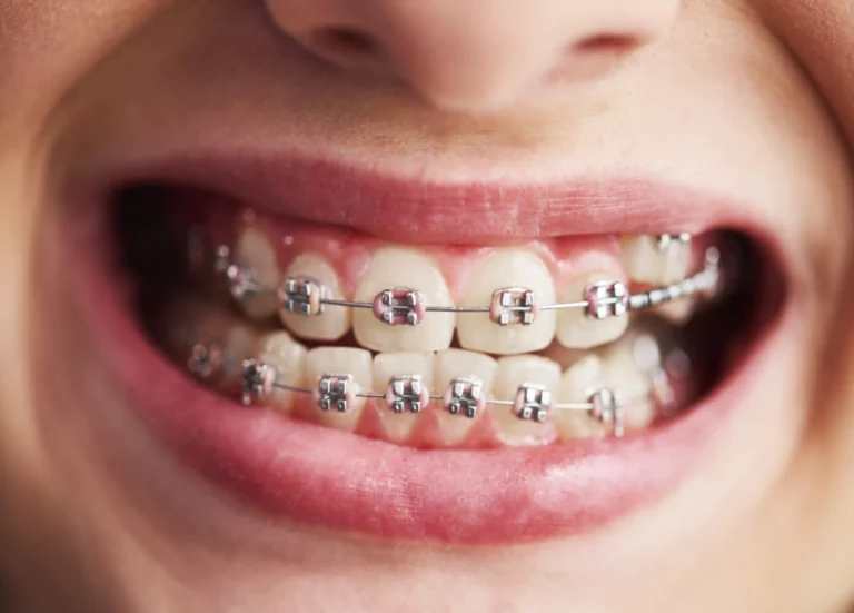 Blog 9 Quanto costa l’apparecchio per i denti