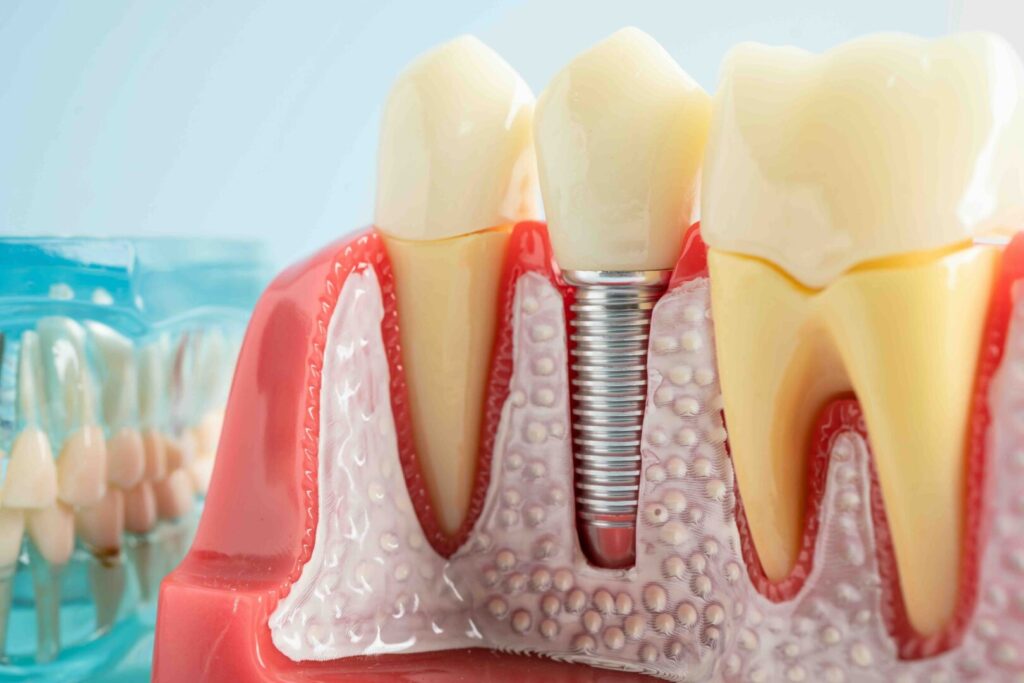 Guida completa implantologia: come ritrovare denti fissi e stabili a Ronchi dei Legionari 1 Guida completa implantologia