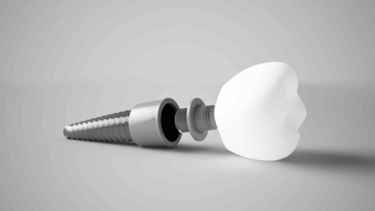 Quanti tipi di impianti dentali ci sono?