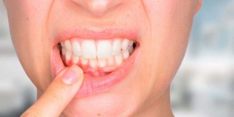 piorrea dei denti